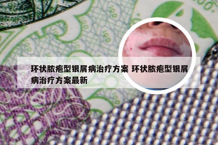 环状脓疱型银屑病治疗方案 环状脓疱型银屑病治疗方案最新
