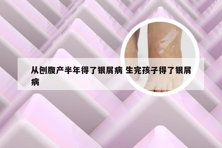 从刨腹产半年得了银屑病 生完孩子得了银屑病