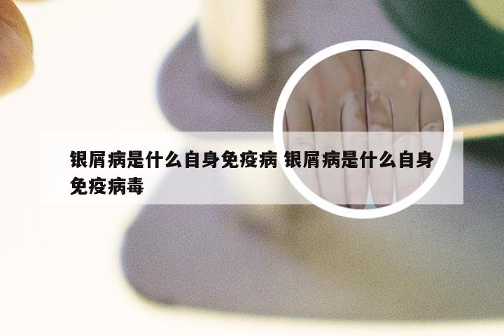 银屑病是什么自身免疫病 银屑病是什么自身免疫病毒