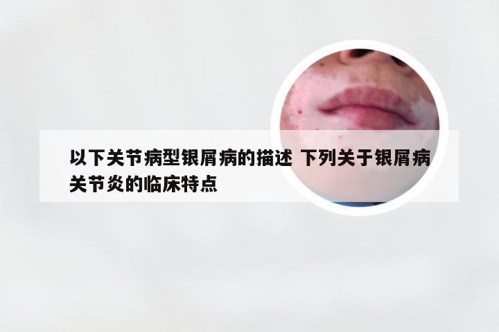 以下关节病型银屑病的描述 下列关于银屑病关节炎的临床特点