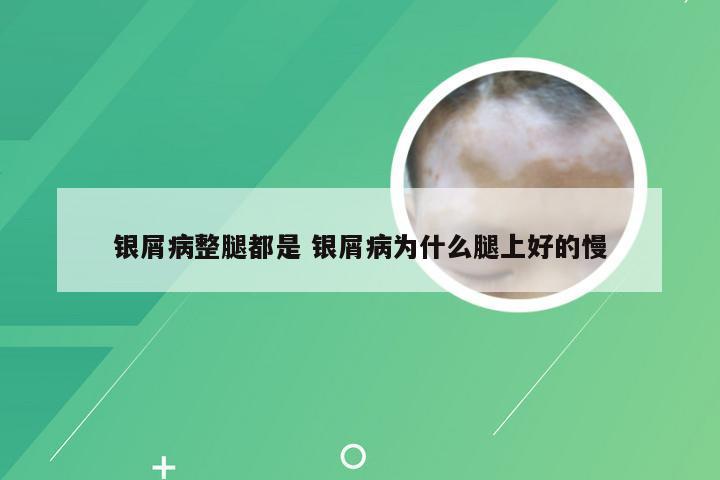 银屑病整腿都是 银屑病为什么腿上好的慢