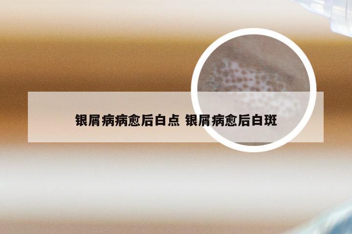 银屑病病愈后白点 银屑病愈后白斑