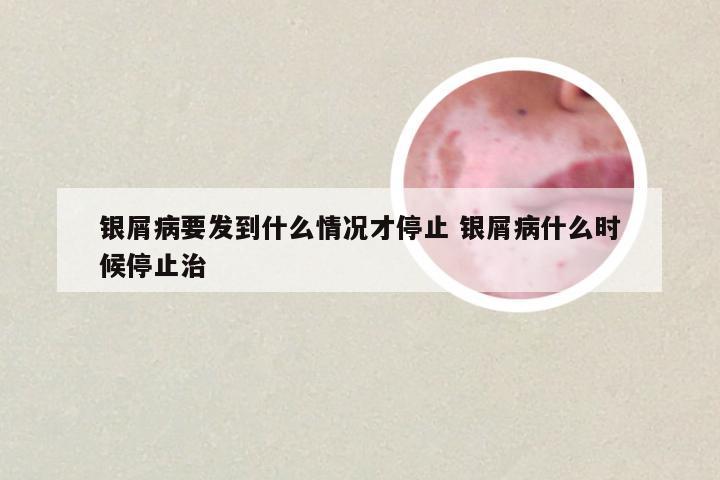 银屑病要发到什么情况才停止 银屑病什么时候停止治