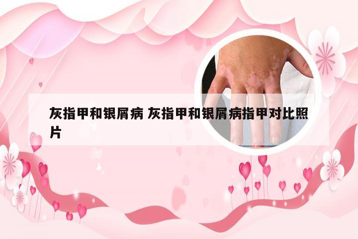 灰指甲和银屑病 灰指甲和银屑病指甲对比照片