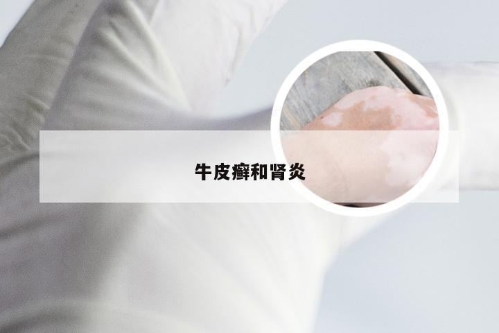 牛皮癣和肾炎