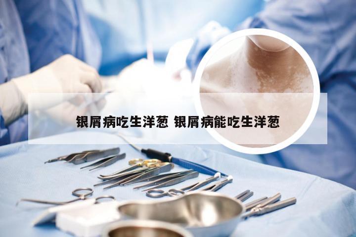 银屑病吃生洋葱 银屑病能吃生洋葱