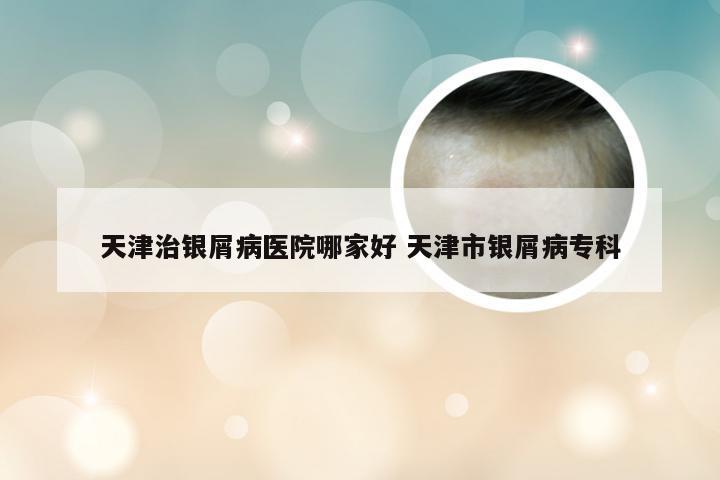 天津治银屑病医院哪家好 天津市银屑病专科