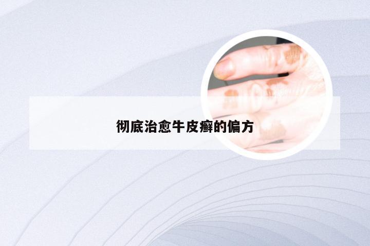 彻底治愈牛皮癣的偏方