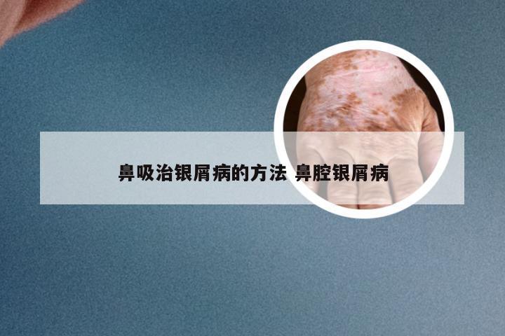 鼻吸治银屑病的方法 鼻腔银屑病
