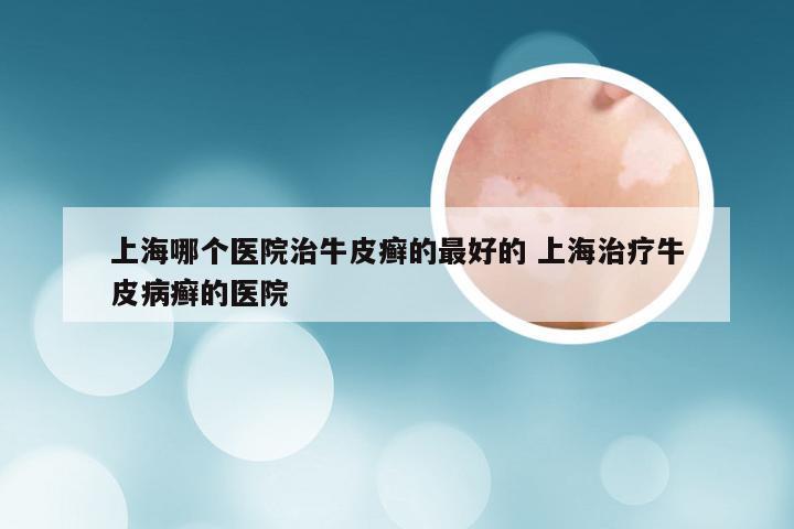 上海哪个医院治牛皮癣的最好的 上海治疗牛皮病癣的医院