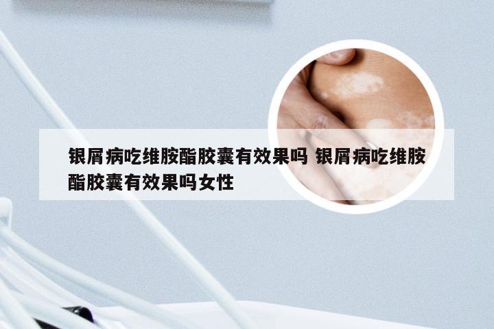 银屑病吃维胺酯胶囊有效果吗 银屑病吃维胺酯胶囊有效果吗女性