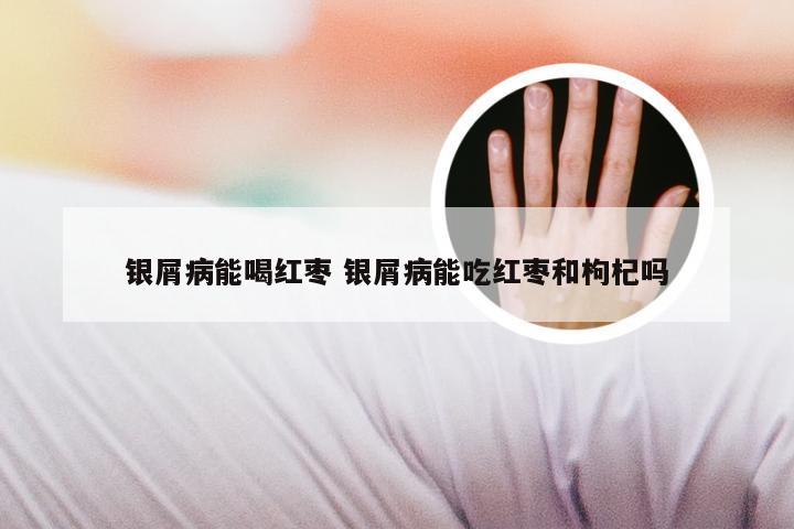 银屑病能喝红枣 银屑病能吃红枣和枸杞吗