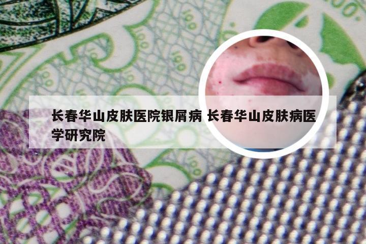长春华山皮肤医院银屑病 长春华山皮肤病医学研究院