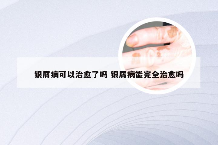 银屑病可以治愈了吗 银屑病能完全治愈吗