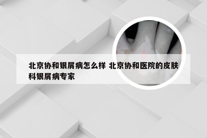 北京协和银屑病怎么样 北京协和医院的皮肤科银屑病专家