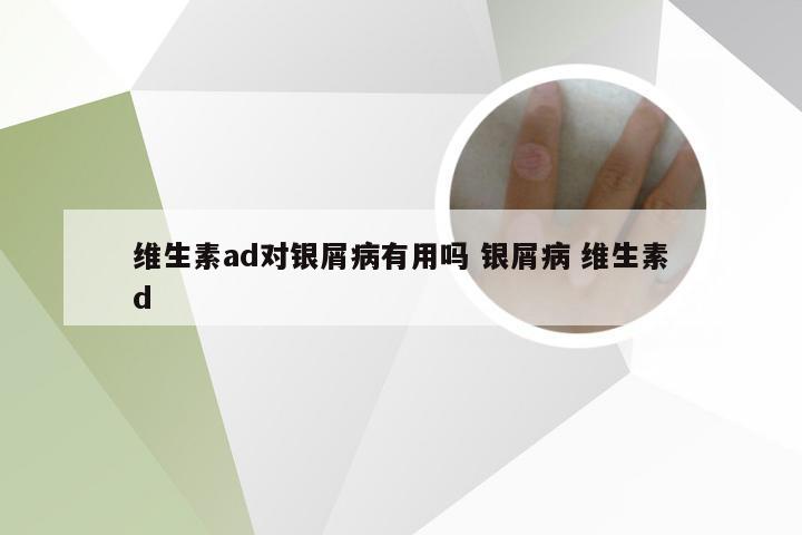 维生素ad对银屑病有用吗 银屑病 维生素d