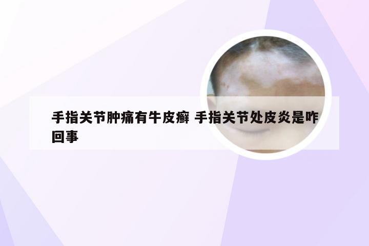 手指关节肿痛有牛皮癣 手指关节处皮炎是咋回事