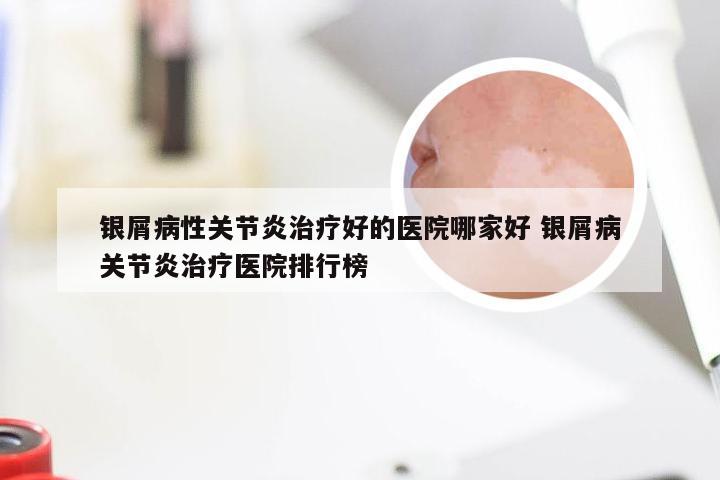 银屑病性关节炎治疗好的医院哪家好 银屑病关节炎治疗医院排行榜