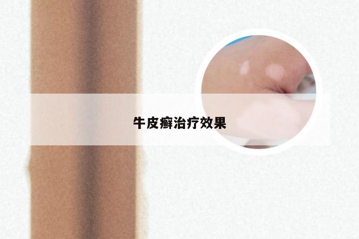 牛皮癣治疗效果