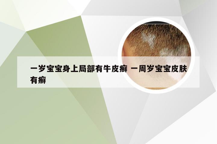 一岁宝宝身上局部有牛皮癣 一周岁宝宝皮肤有癣