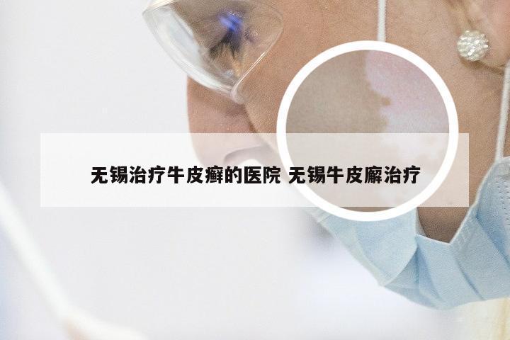 无锡治疗牛皮癣的医院 无锡牛皮廨治疗