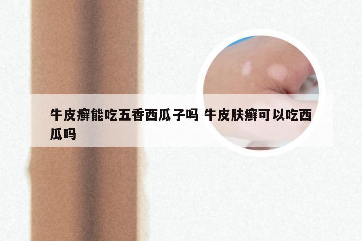 牛皮癣能吃五香西瓜子吗 牛皮肤癣可以吃西瓜吗
