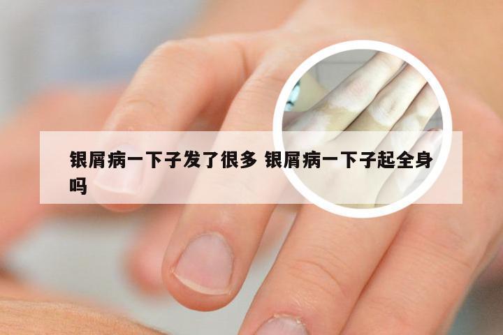 银屑病一下子发了很多 银屑病一下子起全身吗