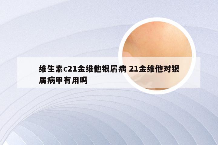 维生素c21金维他银屑病 21金维他对银屑病甲有用吗