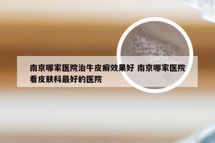 南京哪家医院治牛皮癣效果好 南京哪家医院看皮肤科最好的医院