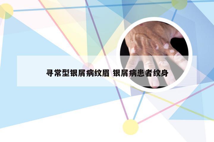 寻常型银屑病纹眉 银屑病患者纹身