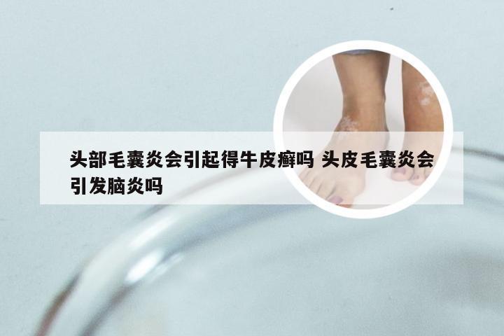 头部毛囊炎会引起得牛皮癣吗 头皮毛囊炎会引发脑炎吗