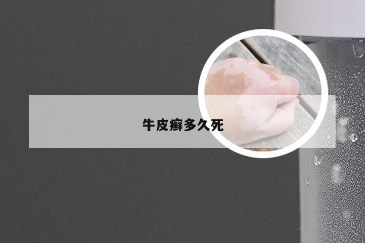 牛皮癣多久死