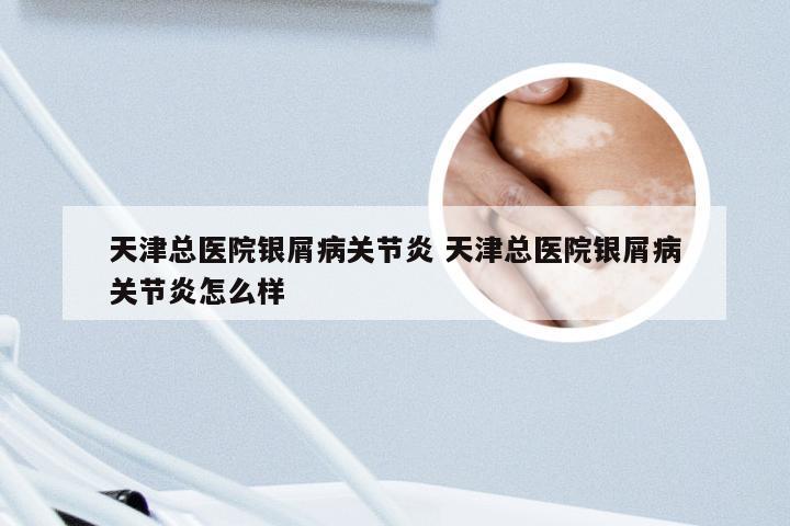 天津总医院银屑病关节炎 天津总医院银屑病关节炎怎么样