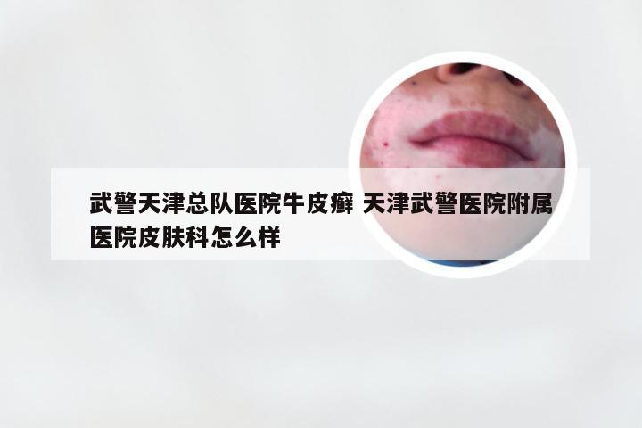 武警天津总队医院牛皮癣 天津武警医院附属医院皮肤科怎么样