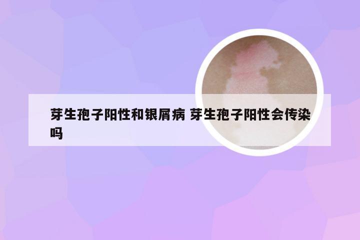 芽生孢子阳性和银屑病 芽生孢子阳性会传染吗