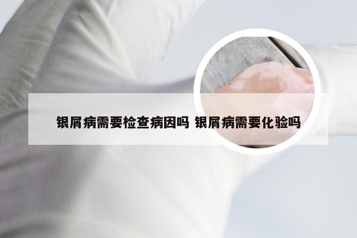银屑病需要检查病因吗 银屑病需要化验吗