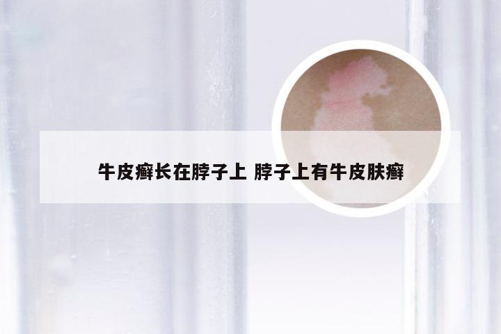 牛皮癣长在脖子上 脖子上有牛皮肤癣