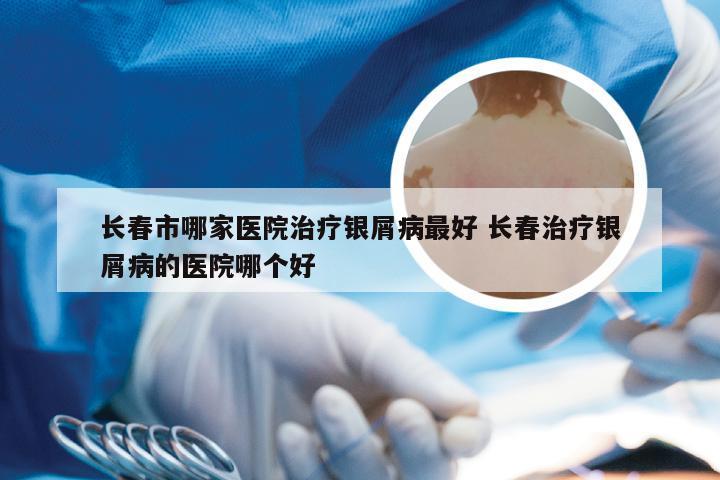 长春市哪家医院治疗银屑病最好 长春治疗银屑病的医院哪个好
