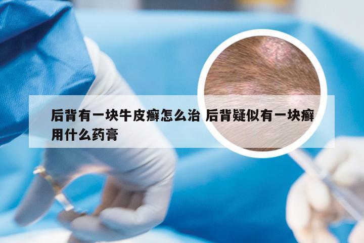 后背有一块牛皮癣怎么治 后背疑似有一块癣用什么药膏