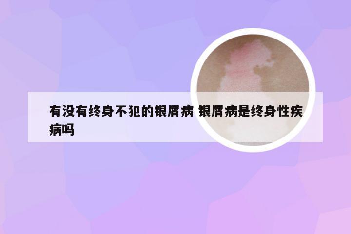有没有终身不犯的银屑病 银屑病是终身性疾病吗