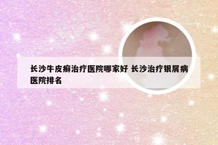 长沙牛皮癣治疗医院哪家好 长沙治疗银屑病医院排名