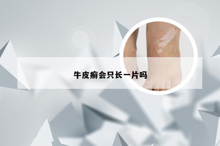 牛皮癣会只长一片吗