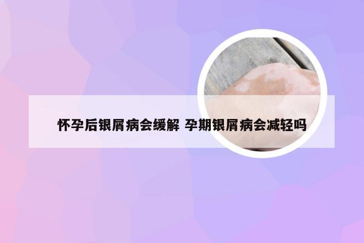 怀孕后银屑病会缓解 孕期银屑病会减轻吗