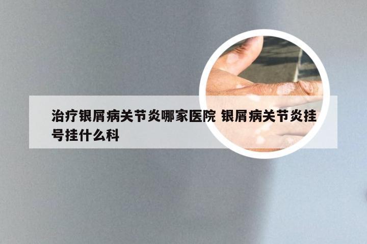 治疗银屑病关节炎哪家医院 银屑病关节炎挂号挂什么科