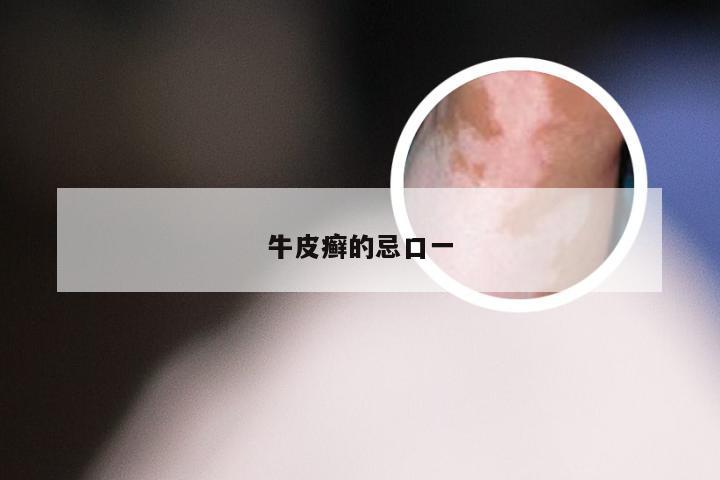 牛皮癣的忌口一
