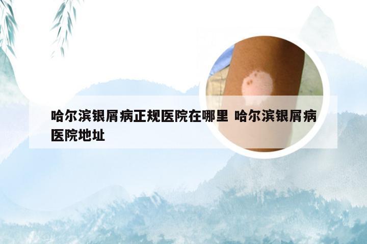 哈尔滨银屑病正规医院在哪里 哈尔滨银屑病医院地址