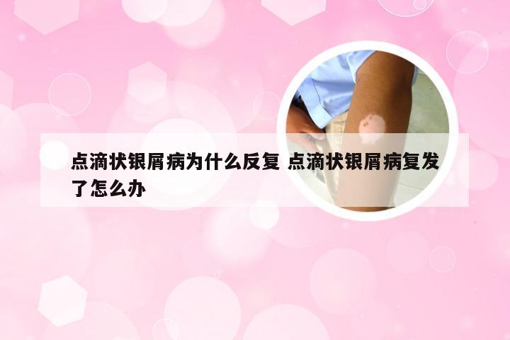 点滴状银屑病为什么反复 点滴状银屑病复发了怎么办