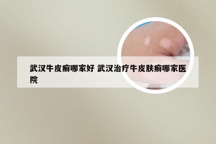 武汉牛皮癣哪家好 武汉治疗牛皮肤癣哪家医院