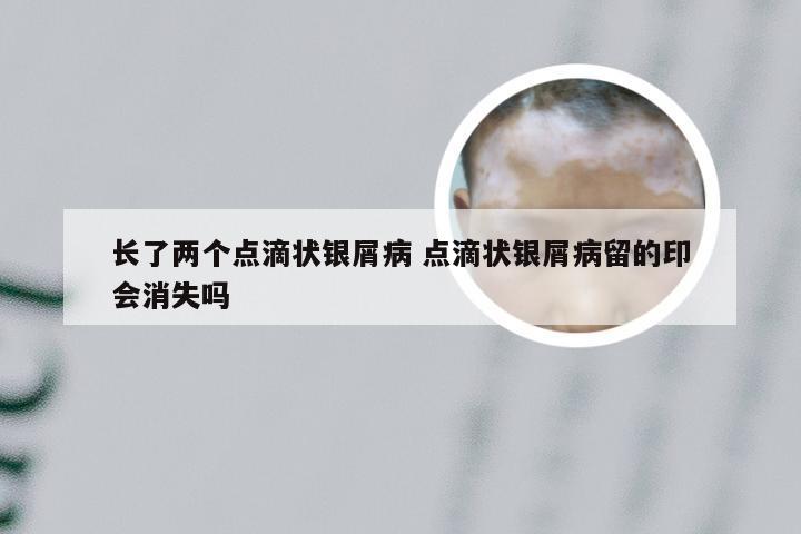 长了两个点滴状银屑病 点滴状银屑病留的印会消失吗
