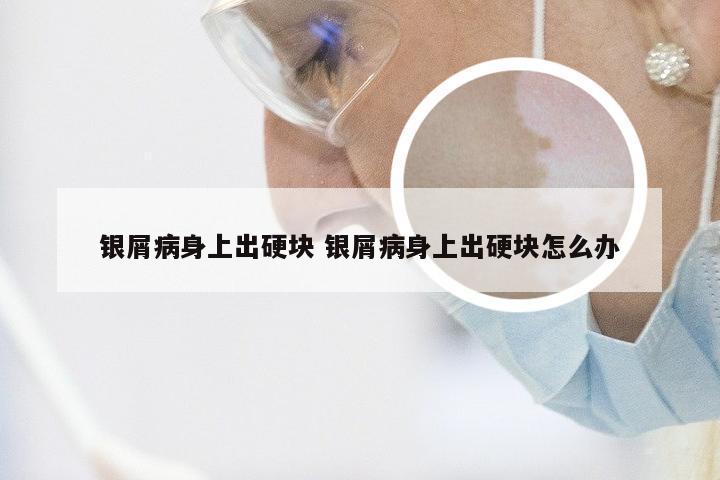 银屑病身上出硬块 银屑病身上出硬块怎么办